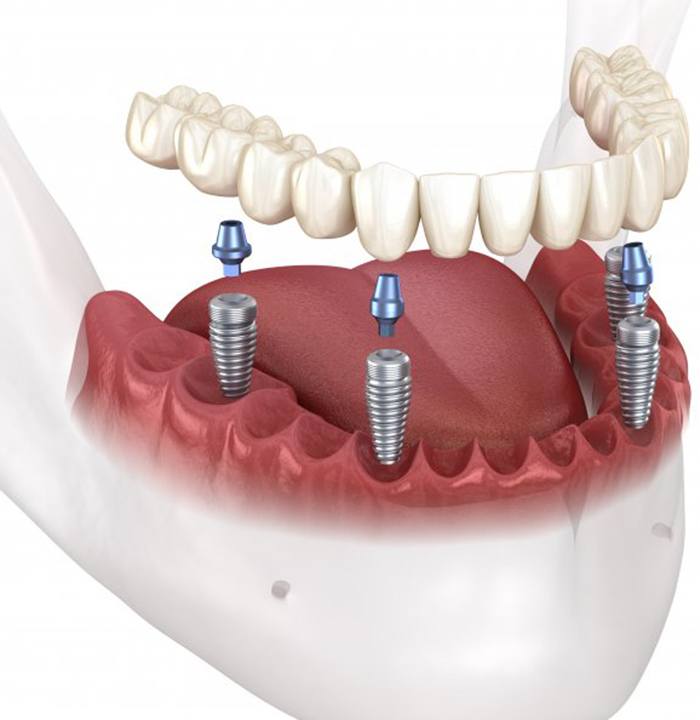 a 3D illustration of all-on-4 dental implants