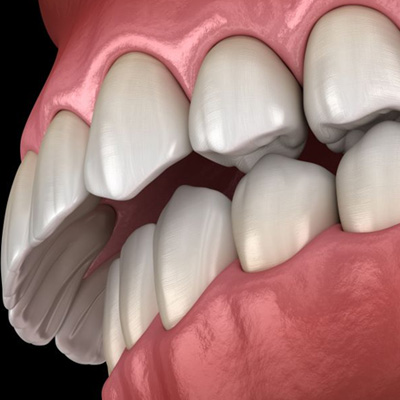 Illustration of an overbite against dark background