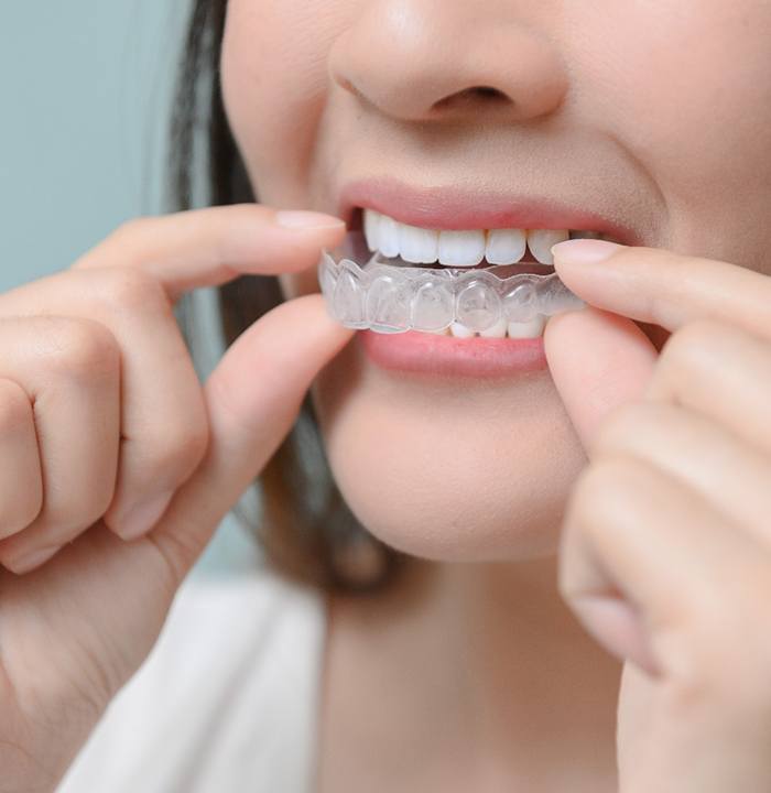 Closeup of patient putting on clear aligner