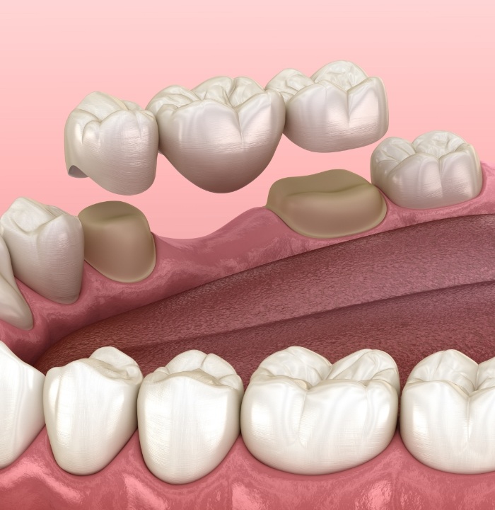 Illustrated dental bridge replacing a missing tooth