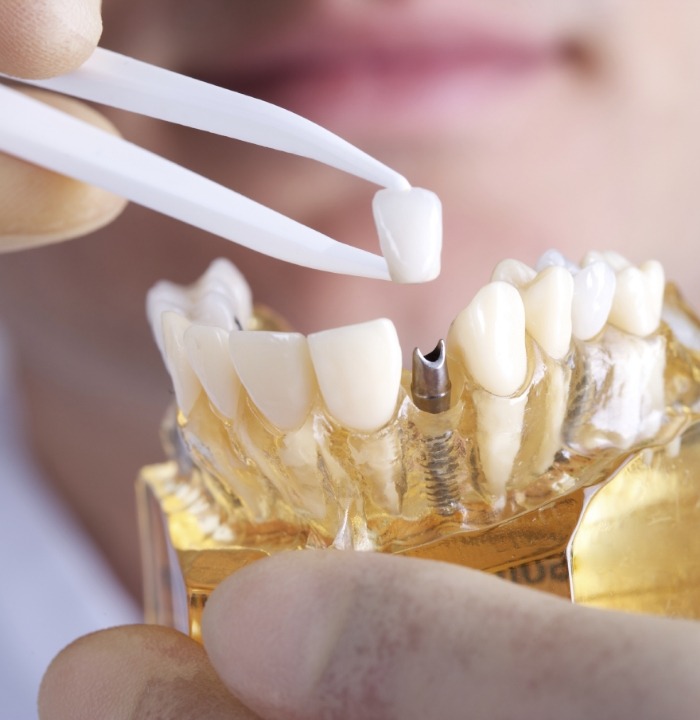 Dental crown being placed on a dental implant model