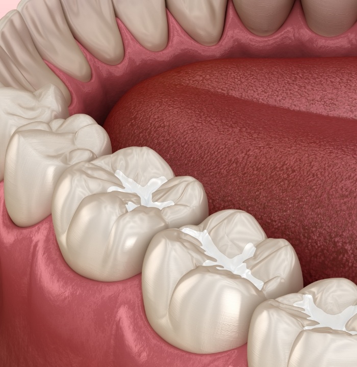 Illustrated row of teeth with white fillings