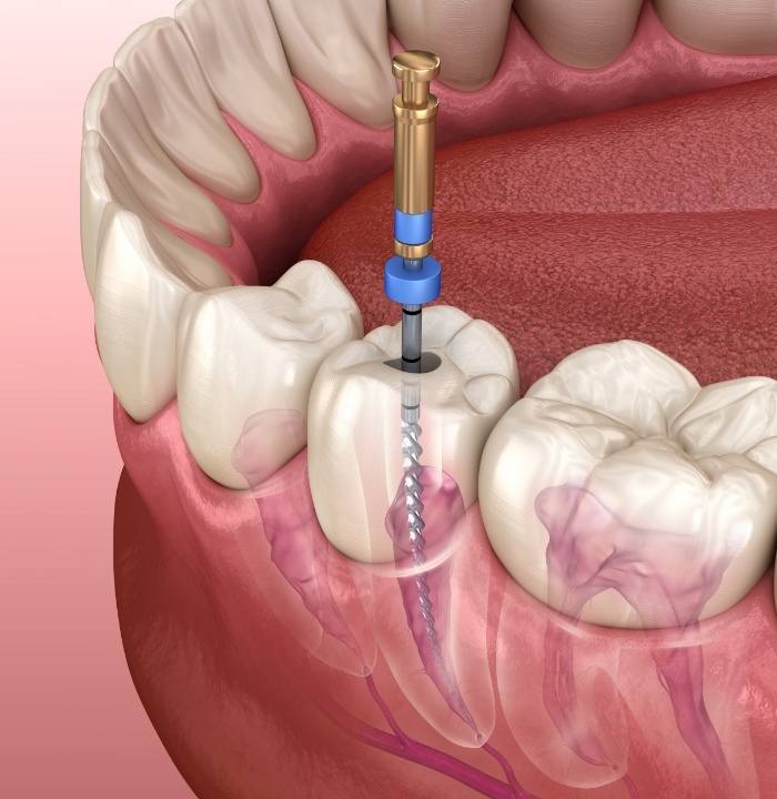 Illustrated dental instrument cleaning inside of tooth during root canal treatment