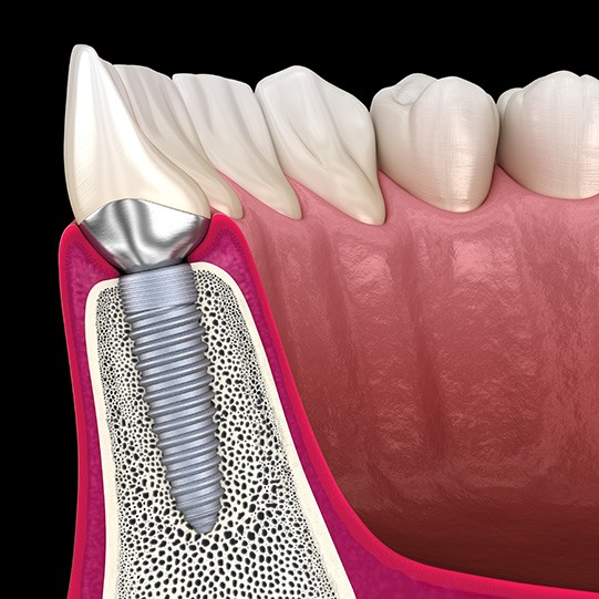 a digital illustration showing a dental implant in the jawbone