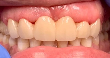 Flawless smile after repairing dental damage