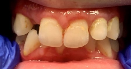 Close up of smile with misaligned teeth and one missing tooth