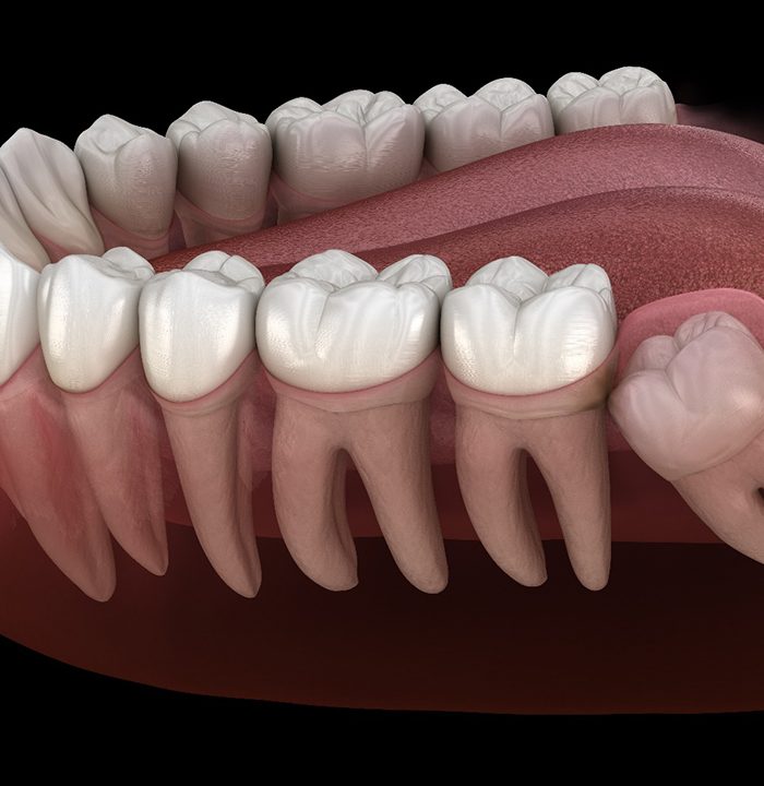 Illustration of wisdom tooth coming in